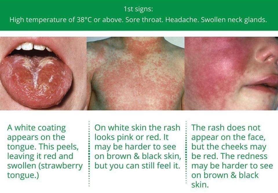 Strep A and Scarlet Fever - King's Medical Centre